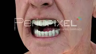 Vídeo 3D Atrofia progresiva de los maxilares con la prótesis removible - Tráiler