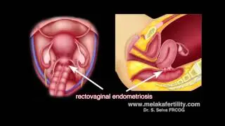 Laparoscopic surgery for endometriosis