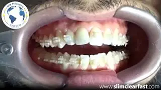 Removal and bonding - SlimClear