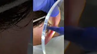 Black head removal on face - Blackheads on back treatment