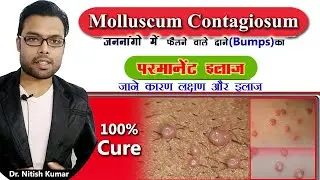 Molluscum Contagiosum का कारण लक्षण और इलाज | Molluscum Contagiosum treatment in Hindi | Dr. Nitish