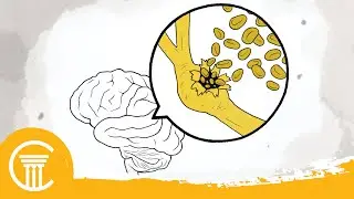 Neurosurgery Malpractice