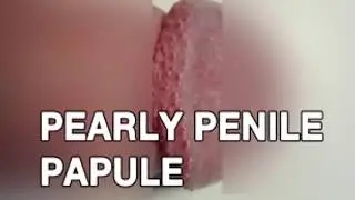 Pearly Penile Papules Removal With Toothpaste | Pearly Penile Papules Removal Toothpaste Home Remedy