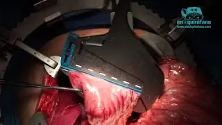 Técnica de Whipple para resección de cáncer de páncreas