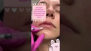 Top and Bottom Lip Injections are NECESSARY for a Proper Lip Flip!