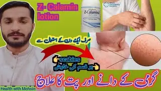 garmi dane khatam krny ka tareeqa | garmi dano ka ilaj | pit ka ilaj | calamine lotion uses | garmi|