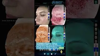MEICET Skin Analyzer:The Starting Point of All Beauty Procedures #skinanalyzer #skincare