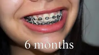 Braces Update: 6 Months In & The Change Is REAL 😳vlog #5