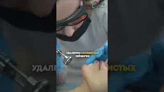 Удаление сосудов на лице.