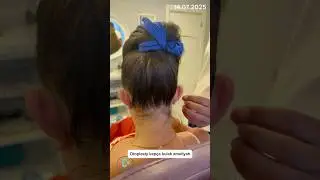 Otoplasty prominent ear surgery