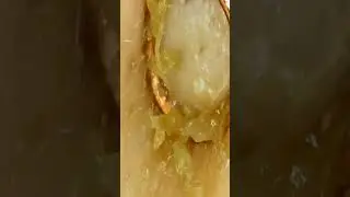 Прыщи и чёрные точки под Микроскопом🤢