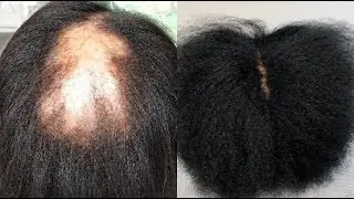 Your hair will GROW like CRAZY! I Promise That After Using This Your Hair Will Never Stop Growing
