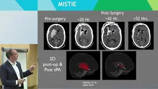 Identification and Treatment of Hemorrhagic Stroke