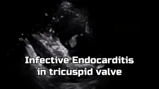 Infective Endocarditis in tricuspid valve