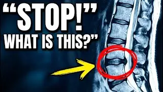 How to Read Your Lumbar MRI Report (Disc Herniation, Bulge & Stenosis Explained)