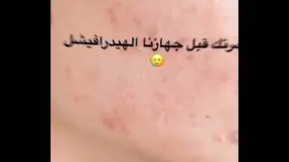 شاهد كيف يتغير وجهي عندما أستخدم جهاز الهيدرافيشل🥳😀