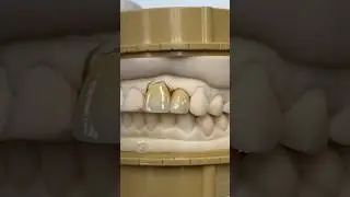 Central and Lateral Incisors @EnvisiontecMain #envisiontec #lsk121shorts #dental #teeth