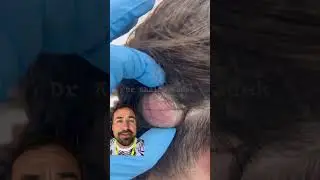What is this ? Dr Khaled explains #skincare LIPOMACYST clinic