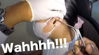GIANT Cockroach Stuck in Woman's Ear | How to Remove It