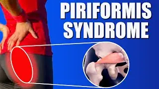 Piriformis Syndrome Relief: Effective Exercises & Posture Tips (No Medication Required)