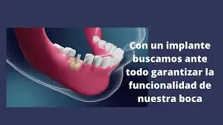 Implante y consecuencias de no reponer