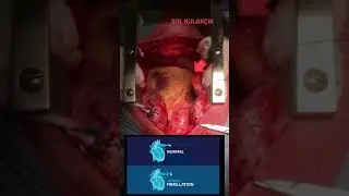 En sevmediğimiz çarpıntı, Atrial Fiibrilasyon, Sağlık, Prof.Dr.Serdar Akgün,