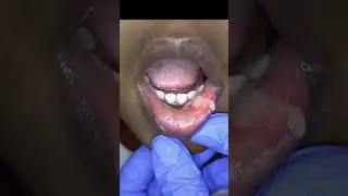 Pediatric Chewed Lip after Dental Anesthesia
