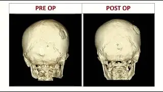 Suyak defektini 3D modellashtirilgan implant yordamida allokranioplastika qilish (06.03.2025).