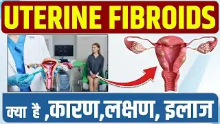 Uterine Fibroids क्या है ,कारण,लक्षण, इलाज | Fibroids Symptoms And Treatment | Fibroids ka ilaaj