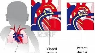 Audio Heart Sound of Patent Ductus Arteriosus (PDA) USMLE - Real time Continous Murmer