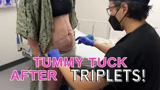 Plastic Surgeon Reveals How I Flattened Her Tummy After Triplets!