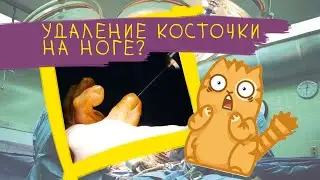 УДАЛЕНИЕ КОСТОЧКИ НА НОГЕ! Честно об операции...