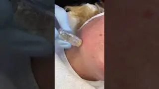 Gold Filltox Facial! 