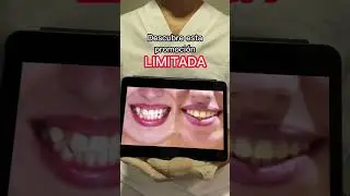 Se Buscan Personas que quieran AHORRAR 600€ en Ortodoncia Invisible