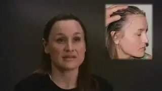 FUE and Strip Hair Transplant specialists Shapiro Medical Group interview with Cindy