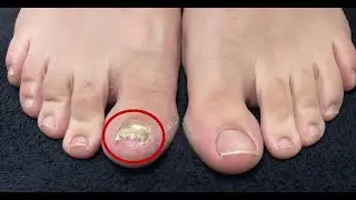 Thick and Discolored Nail Makes a Dramatic Recovery - Dr. Lloyd's Laser Treatment for Fungal Nails