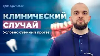 Клинический случай  Условно съёмный протез. Протезы на имплантатах