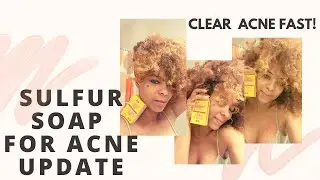 Product update for sulfur soap. Get rid of acne fast! Works great as a mask too. (part 2)