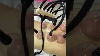 Вакуумный массаж Паук