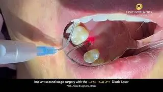 Implant second stage surgery with the D-Storm™ Diode Laser
