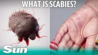 Dr Philippa Kaye on the signs, symptoms and best ways to avoid catching scabies