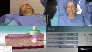 Accutite - Vücut Şekillendirme Canlı Cerrahi  Mayıs 2019 - bodySCULPT-LiveStream-May-3-2019
