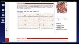 Heart block