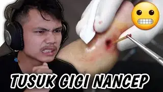 MENCABUT DURI NANCEP DI KAKI  SAMPE BOLONG😱😱