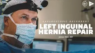 Laparoscopic Recurrent Left Inguinal Hernia Repair by Dr. James Wall | Case Trailer