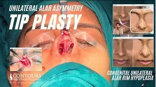 TIP PLASTY | CONGENITAL UNILATERAL ALAR RIM HYPOPLASIA | RHINOPLASTY | CONTOURS PLASTIC SURGERY
