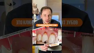 От чего появляется клиновидный дефект Зубов?