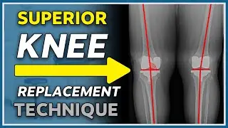 New game changing knee replacement technique explained - 