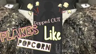 Dandruff Popped Out Like Popcorn