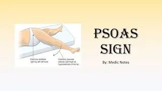 Psoas sign - how to elicit, causes, mechanism